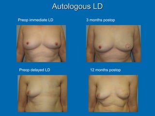 Autologous LDAutologous LD
Preop immediate LD 3 months postop
Preop delayed LD 12 months postop
 