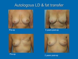 Autologous LD & fat transferAutologous LD & fat transfer
Pre-op 5 years post-op
Pre-op
2 years post-op
 
