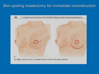 Skin sparing mastectomy for immediate reconstructionSkin sparing mastectomy for immediate reconstruction
 