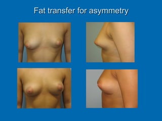 Fat transfer for asymmetryFat transfer for asymmetry
 