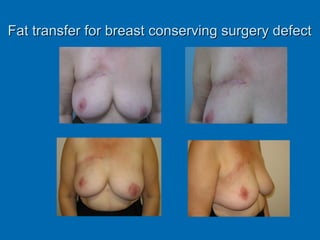 Fat transfer for breast conserving surgery defectFat transfer for breast conserving surgery defect
 