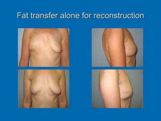 Fat transfer alone for reconstructionFat transfer alone for reconstruction
 