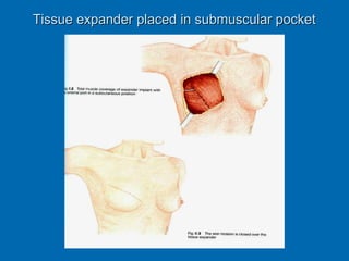 Tissue expander placed in submuscular pocketTissue expander placed in submuscular pocket
 