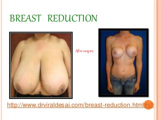 BREAST REDUCTION
After surgery
http://www.drviraldesai.com/breast-reduction.html#s9
 