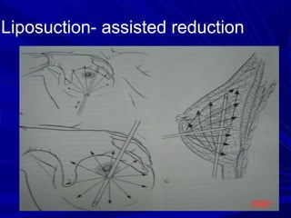 breast reduction ppt.ppt