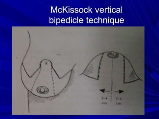 breast reduction ppt.ppt