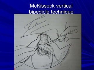breast reduction ppt.ppt