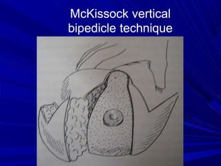 breast reduction ppt.ppt