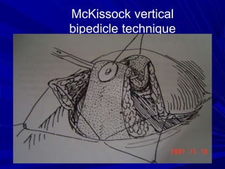 breast reduction ppt.ppt