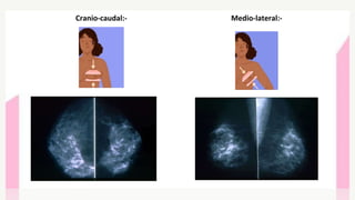 Cranio-caudal:- Medio-lateral:-
 