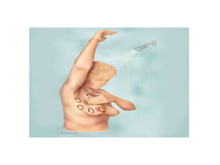 Breast self examination
