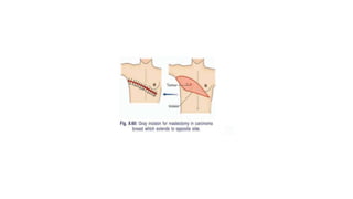 breast-surgery-pptx