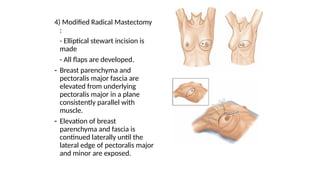 Elliptical Incisional breast surgery, general surgery, cancers | PPTX