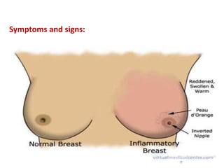 Symptoms and signs:
painless lump in the breast.
Changes in the size or shape of a breast.
Dimpling or thickening of some of the skin
on a part of a breast.
The nipple becoming inverted (turning in).
Rarely, a discharge occurring from a nipple
redness and warmth
 
