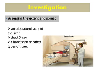 Investigation
 an ultrasound scan of
the liver
chest X-ray,
a bone scan or other
types of scan.
• Assessing the extent and spread
 