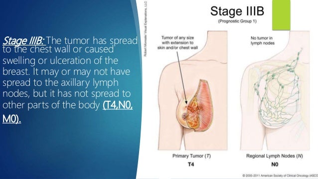 Staging For Ca Breast And Early Breast Cancer