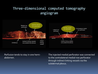 Three-dimensional computed tomography
                      angiogram




Perfusion tends to stay in one hemi-   The injected medial perforator was connected
abdomen.                               to the contralateral medial row perforator
                                       through indirect linking vessels via the
                                       subdermal plexus.
 