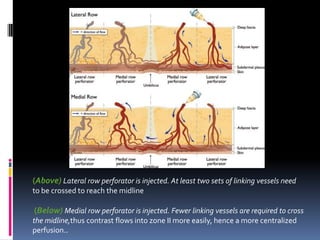 (Above) Lateral row perforator is injected. At least two sets of linking vessels need
to be crossed to reach the midline

(Below) Medial row perforator is injected. Fewer linking vessels are required to cross
the midline,thus contrast flows into zone II more easily, hence a more centralized
perfusion..
 