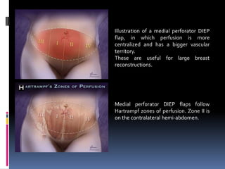 Illustration of a medial perforator DIEP
flap, in which perfusion is more
centralized and has a bigger vascular
territory.
These are useful for large breast
reconstructions.




Medial perforator DIEP flaps follow
Hartrampf zones of perfusion. Zone II is
on the contralateral hemi-abdomen.
 