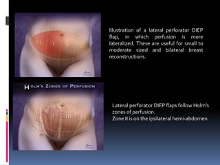 Illustration of a lateral perforator DIEP
flap, in which perfusion is more
lateralized. These are useful for small to
moderate sized and bilateral breast
reconstructions.




 Lateral perforator DIEP flaps follow Holm’s
 zones of perfusion.
 Zone II is on the ipsilateral hemi-abdomen.
 