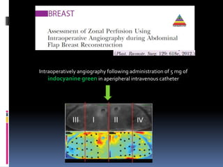 Intraoperatively angiography following administration of 5 mg of
    indocyanine green in aperipheral intravenous catheter
 