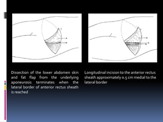 Dissection of the lower abdomen skin       Longitudinal incision to the anterior rectus
and fat flap from the underlying           sheath approximately 0.5 cm medial to the
aponeurosis terminates when the            lateral border
lateral border of anterior rectus sheath
is reached
 