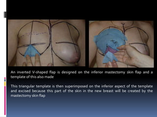 An inverted V-shaped flap is designed on the inferior mastectomy skin flap and a
template of this also made

This triangular template is then superimposed on the inferior aspect of the template
and excised because this part of the skin in the new breast will be created by the
mastectomy skin flap
 