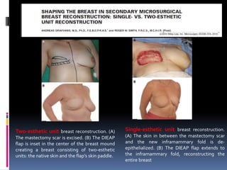 Two-esthetic unit breast reconstruction. (A)         Single-esthetic unit breast reconstruction.
The mastectomy scar is excised. (B) The DIEAP        (A) The skin in between the mastectomy scar
flap is inset in the center of the breast mound      and the new inframammary fold is de-
creating a breast consisting of two-esthetic         epithelialized. (B) The DIEAP flap extends to
units: the native skin and the flap’s skin paddle.   the inframammary fold, reconstructing the
                                                     entire breast
 