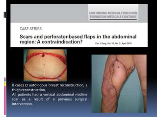 8 cases (7 autologous breast reconstruction, 1
thigh reconstruction.
All patients had a vertical abdominal midline
scar as a result of a previous surgical
intervention.
 