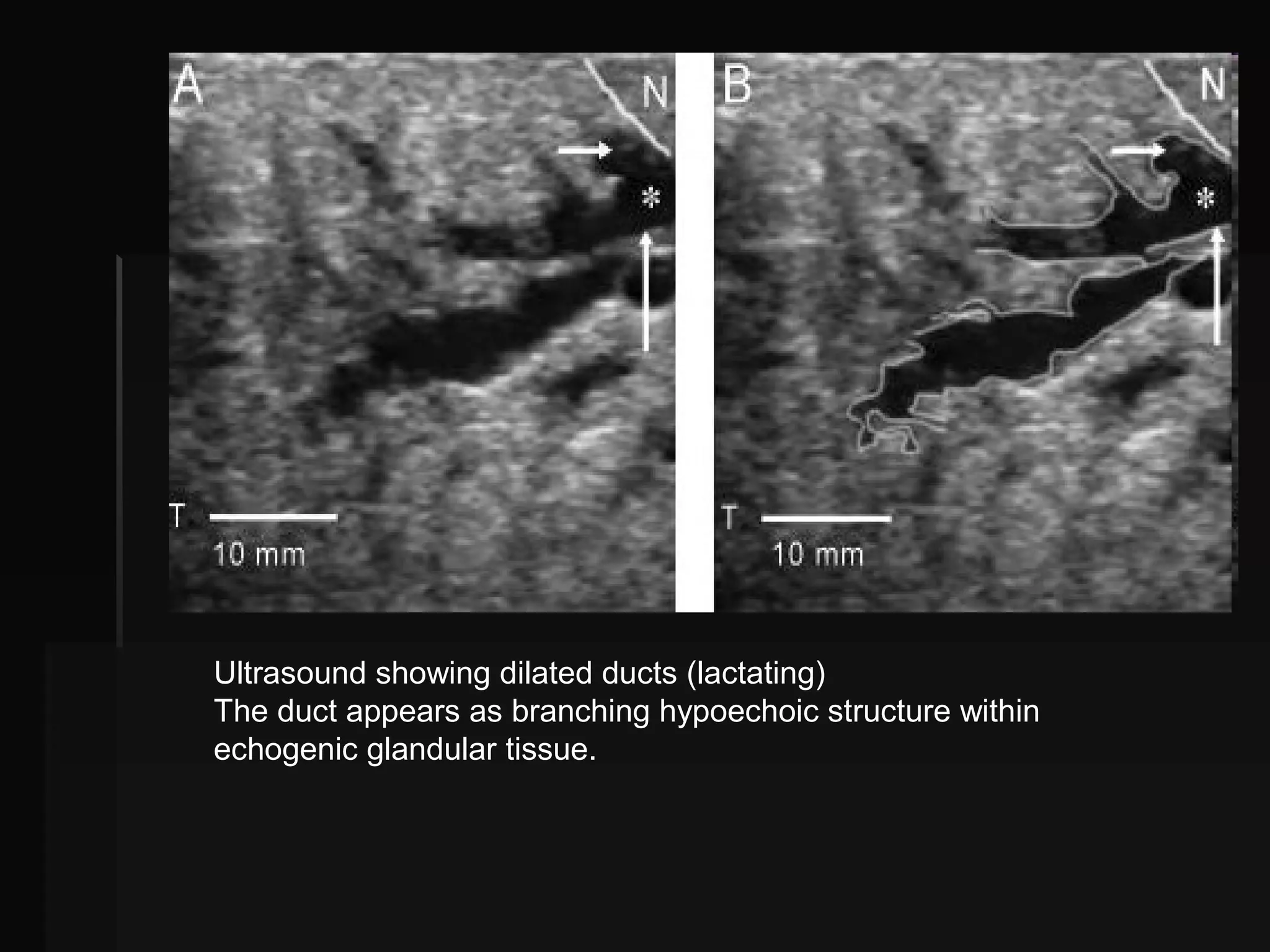 Breast ultrasound | PPT