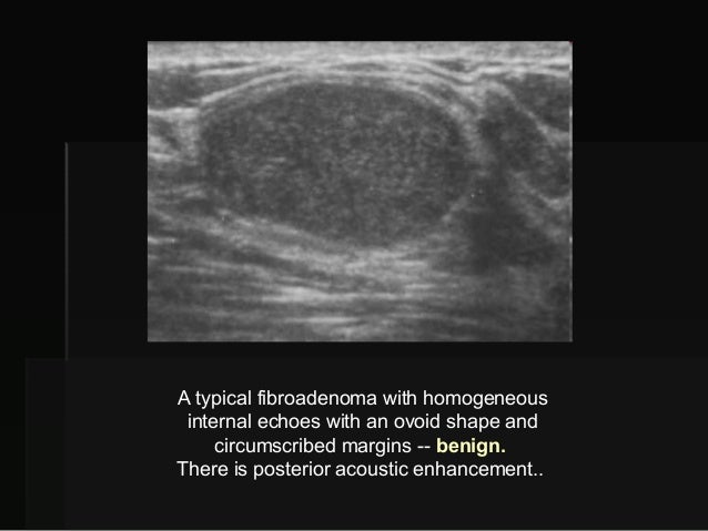 The Radiology Assistant : Ovarian Cysts - Common lesions