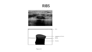 Ultrasound For Rib Example Breast ultrasound lecture for medical only | PPTX