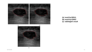 4/17/2018 11
(a) result by NSSLS,
(b) result by FCMLS
(c) radiologist’s result
 