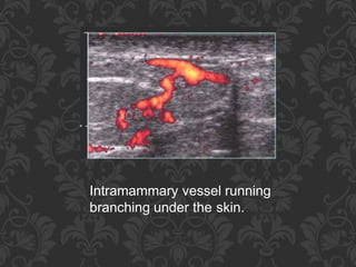 Intramammary vessel running
branching under the skin.
 