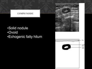 LYMPH NODE
•Solid nodule
•Ovoid
•Echogenic fatty hilum
 