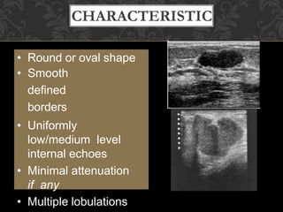 BENIGN
CHARACTERISTIC
S
• Round or oval shape
• Smooth
defined
borders
• Uniformly
low/medium level
internal echoes
• Minimal attenuation
if any
• Multiple lobulations
 