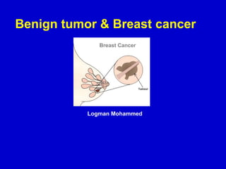 Benign tumor & Breast cancer
Logman Mohammed
 