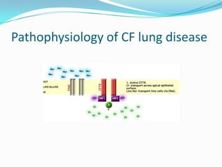 Pathophysiology of CF lung disease
 