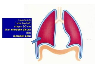 Luka tusuk
Luka tembak
masuk 3-5 cm
akan merobek pleura
dan
merobek paru
 
