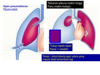 Terapi : tutup lobang agar udara yang
masuk tidak bertambah lagi
Tutup rapat-rapat
Kasa + vaselin
Tekanan pleura makin tinggi
Paru makin kolaps
Open pneumothorax
Pleura robek
udara
masuk
 