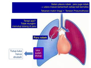 Selain pleura robek, paru juga robek
→ udara masuk bertambah setiap kali bernafas
Tekanan makin tinggi = Tension Pneumothorax
Terapi apa?
Tidak mungkin
menutup lubang di paru
Paru robek
luka
sudah
ditutup
Tutup luka
harus
dirubah
 