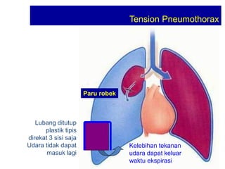 Tension Pneumothorax
Paru robek
Lubang ditutup
plastik tipis
direkat 3 sisi saja
Udara tidak dapat
masuk lagi
Kelebihan tekanan
udara dapat keluar
waktu ekspirasi
 