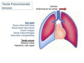 Sisi sakit
Suara nafas berkurang
Suara ketuk hiper-sonor
(suara rongga)
Gerak nafas tertinggal
Vena leher mengembang
Tanda umum
Distress nafas
Hipotensi, nadi cepat
trachea
terdorong ke sisi sehat
Tanda Pneumotoraks
tension
 