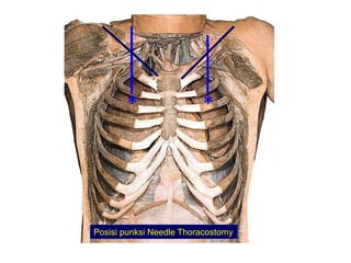 * *
Posisi punksi Needle Thoracostomy
 