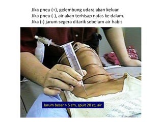 Jika pneu (+), gelembung udara akan keluar.
Jika pneu (-), air akan terhisap nafas ke dalam.
Jika (-) jarum segera ditarik sebelum air habis
Jarum besar > 5 cm, spuit 20 cc, air
 