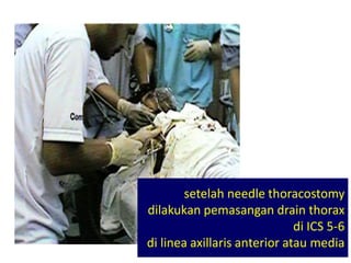 setelah needle thoracostomy
dilakukan pemasangan drain thorax
di ICS 5-6
di linea axillaris anterior atau media
 