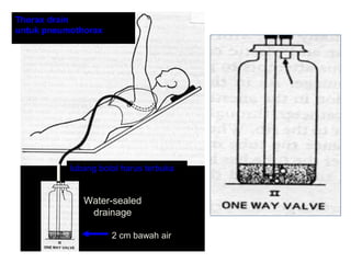 Water-sealed
drainage
2 cm bawah air
Thorax drain
untuk pneumothorax
lubang botol harus terbuka
 