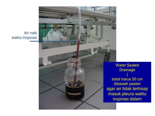 Water Sealed
Drainage
|
botol harus 50 cm
dibawah pasien
agar air tidak terhisap
masuk pleura waktu
inspirasi dalam
Air naik
waktu inspirasi
 