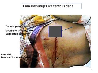 34
Sehelai plastik tipis
di-pleister 3 sisinya →
Jadi katub satu arah
Cara menutup luka tembus dada
Cara dulu:
kasa steril + vaselin steril
 