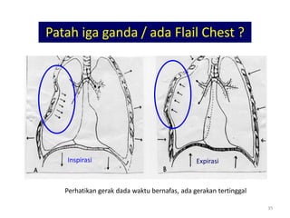 35
Patah iga ganda / ada Flail Chest ?
Perhatikan gerak dada waktu bernafas, ada gerakan tertinggal
Inspirasi Expirasi
 
